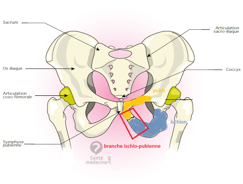 branches ischio et ilio pubiennes - fracture branche ilio pubienne traitement